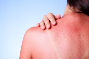 Patarimai, kaip padėti odai po nudegimų saulėje